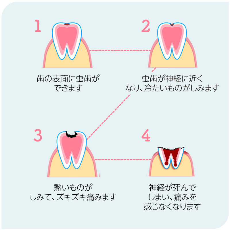 虫歯の状態の目安
